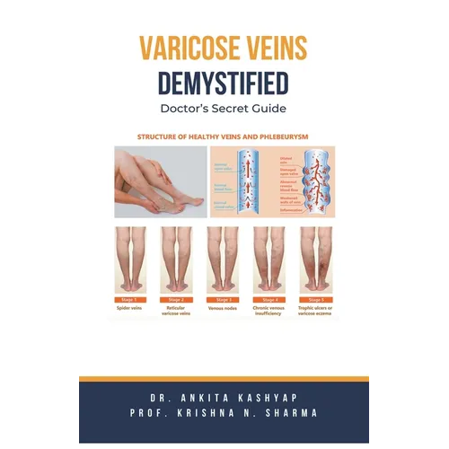 Varicose Veins Demystified: Doctor's Secret Guide - Paperback